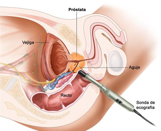 posibles resultados de biopsia de prostata