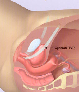 Cirugia incontinencia (TVT)