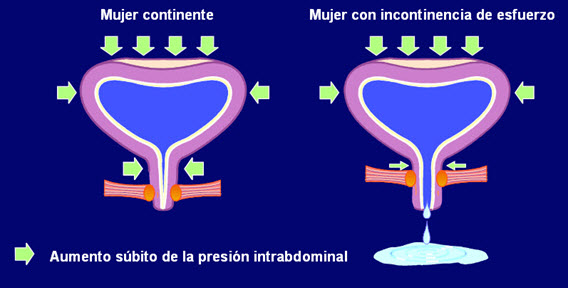 Incontinencia urinaria mujer